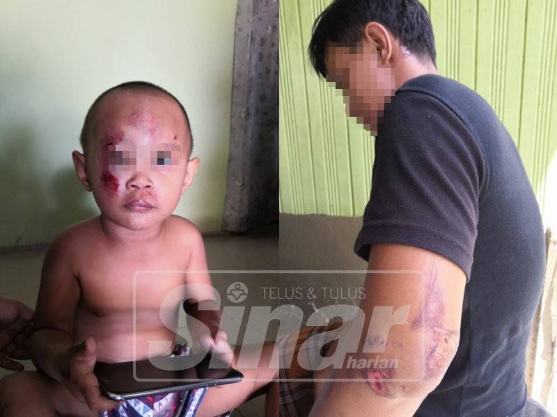 Muhammad Ashraf (kiri) yang cedera pada muka dan dahi. Suhaimi turut cedera di tepi pinggang dan lengan kirinya selepas bergelut dengan suspek.