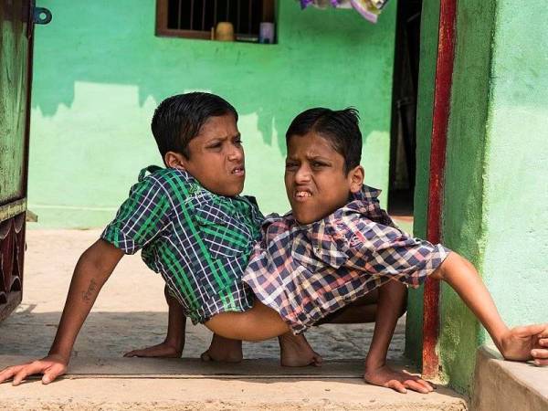 Pasangan kembar siam Shivanath dan Shivram Sahu dari India gembira menjalani kehidupan bersama. - Foto Basit Umer/Barcroft Images