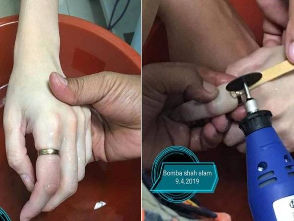 Kiri: Mangsa memakai cincin yang didakwa untuk tujuan perubatan - Foto: Bomba dan Penyelamat Shah Alam. (Gambar kanan: Bomba menggunakan alat pemotong 'air grinder' untuk memotong cincin dipakai mangsa.)