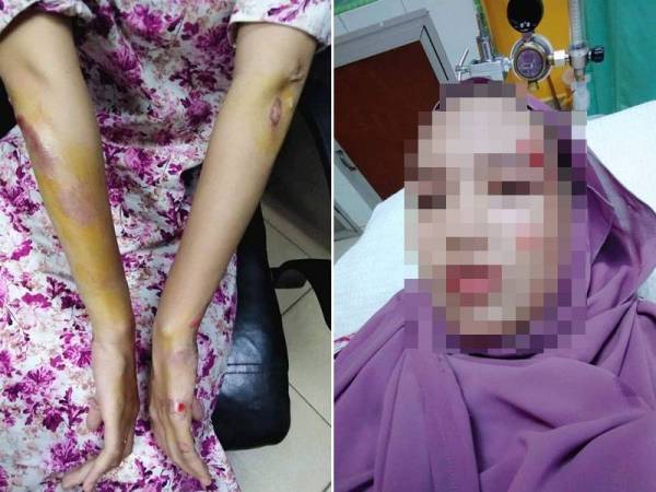 Mangsa mengalami kecederaan di tangan dan di muka selepas beg duitnya disamun.