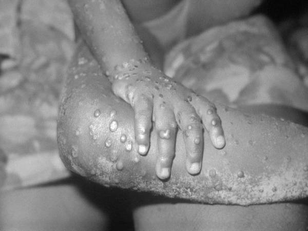 Monkeypox - Foto Wikipedia