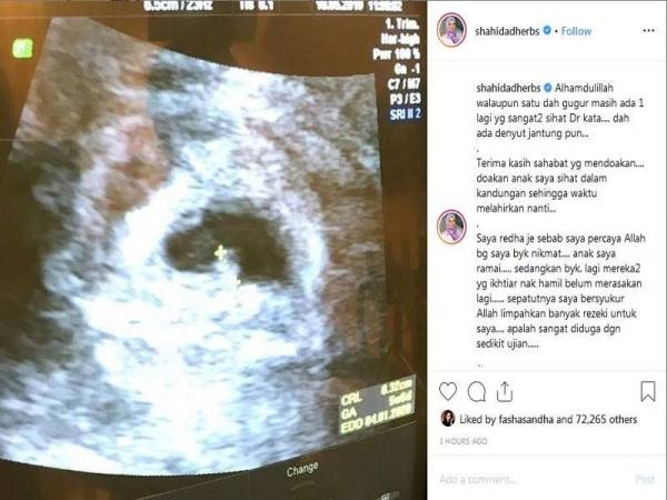 Salah seorang bayi dalam kandungan Nur Shahida berada dalam keadaan sihat.