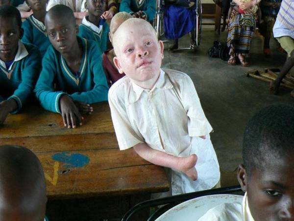 Golongan albino di Tanzania sering diculik dan bahagian tubuh mereka diambil untuk digunakan sebagai tangkal dan ramuan ajaib dengan kepercayaan ia akan membawa kekayaan dan nasib baik.
