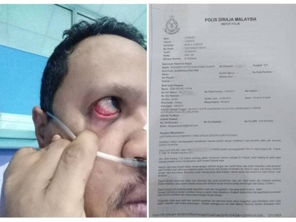 Azmi menunjukkan kesan merah pada matanya susulan kecuaian doktor berkenaan. Gambar kanan: Laporan polis dibuat Azmi susulan kejadian itu.