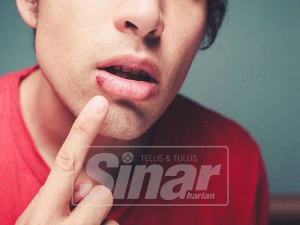 TERDEDAH pada cuaca panas dan kurang minum air boleh menyebabkan masalah kulit bibir kering dan pecah.