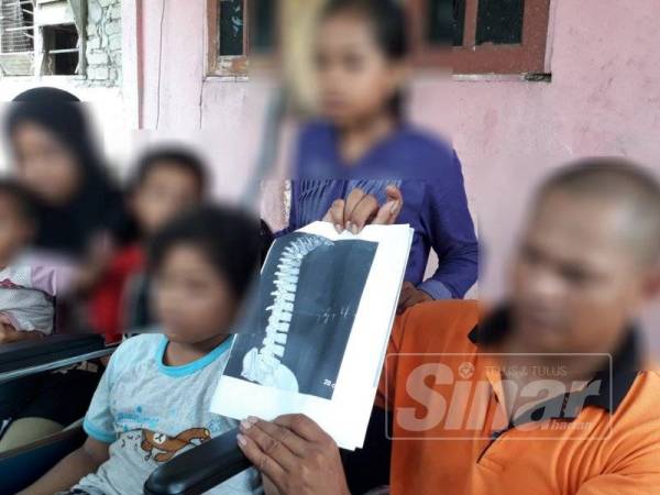 Ahmad bersama keluarganya menunjukkan salinan foto x-ray tulang belakang Angah (berkerusi roda).