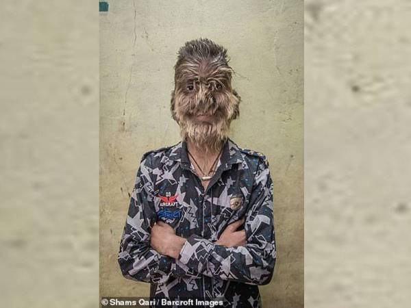 Gambar fail menunjukkan seorang remaja di India yang mengalami 'sindrom werewolf'.