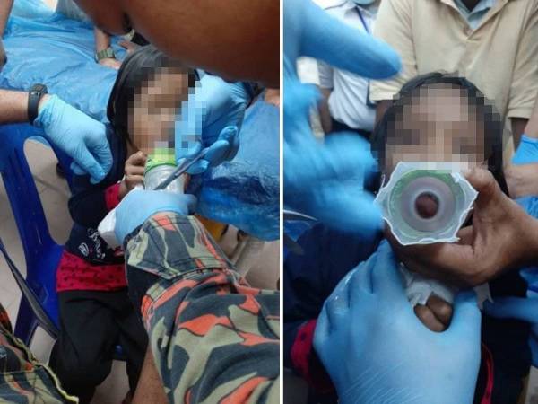 Anggota bomba membantu kanak-kanak berusia enam tahun di Hospital Baling, Kedah untuk mengeluarkan lidahnya yang tersangkut pada botol.