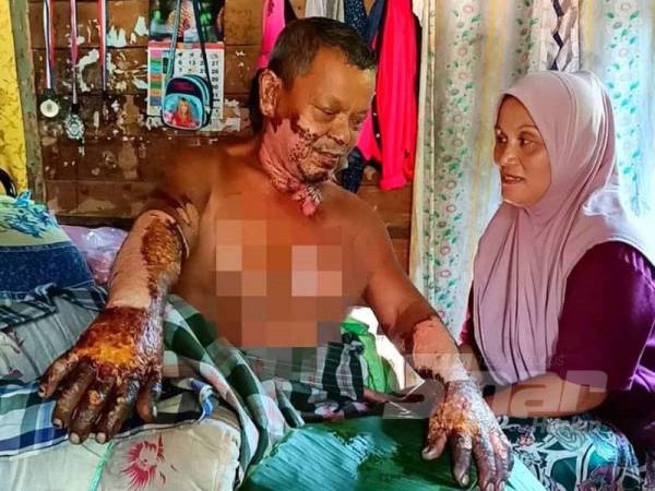 Mohd Nor terpaksa berhenti melakukan kerjanya sebagai mekanik buat sementara waktu selepas kedua belah tangannya melecur akibat disambar api ketika membaik pulih sebuah van di Kampung Tasek Garu, Bukit Pak Junoh.