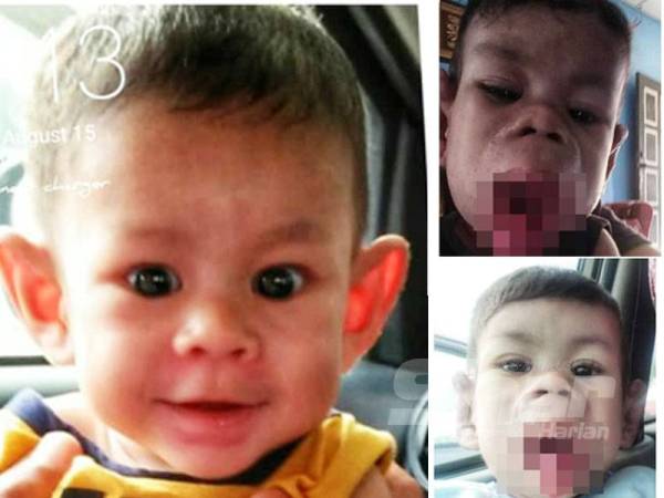 Keadaan Muhammad Aqil Aqma sebelum dan selepas penderitaan akibat ketumbuhan di mulut.