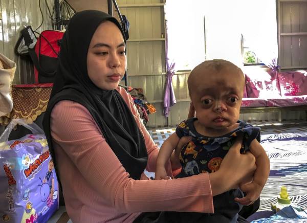 Nor Akma Aini Azmee, 24, menunjukkan anaknya Muhammad Hafiy Affan Mohd Hasiif sembilan bulan yang mengalami penyakit ‘Pfeiffer syndrome’ sehingga sebahagian kedua-dua kelopak matanya terpaksa dijahit ketika berusia seawal dua bulan bagi mengelakkan bebola matanya terkeluar