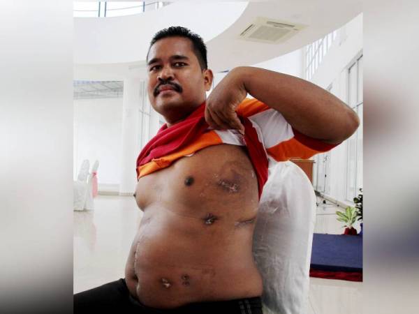 Sarjan Norihan Tari, 39, menunjukkan kesan menjalani pembedahan membuang peluru di dalam badannya selepas berbalas tembakan dengan sekumpulan penyeludup di sempadan Malaysia-Thailand pada bulan lalu di Batalion 3 Pasukan Gerakan Am, Bidor hari ini. - Foto Bernama