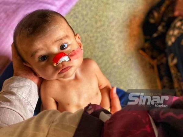 Muhammad Aisy Dayyan,11 bulan yang mengidap pelbagai penyakit antaranya jantung berlubang, tulang belakang yang bengkok sejak lahir.