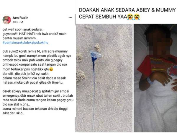 Tangkap layar status dimuat naik seorang pengguna media sosial Facebook mengenai insiden terkena obor-obor beracun yang dilihat mirip kepada spesies portuguese man o' war.