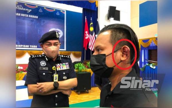 Telinga kiri Mohd Hanif yang cedera dan menerima jahitan akibat digigit peragut dalam kejadian pada awal pagi Ahad. - Foto Sinar Harian