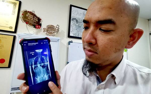 Dr Mohd Zaqrul Razmal menunjukkan X-ray keadaan tulang belakang anaknya yang bengkok