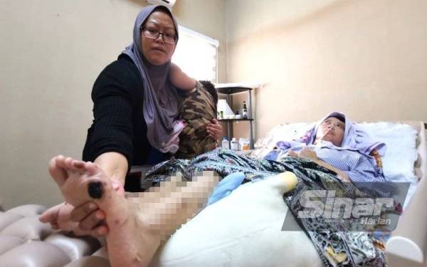 Fauziah menunjukkan kudis di kaki Jahidah.