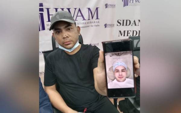 Adam berkongsi gambar sebelum dia menjalani pembedahan hidung di klinik kecantikan berkenaan.