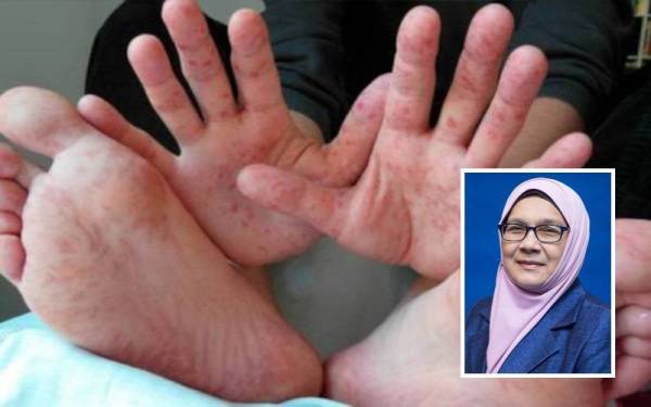 Sebanyak 4,383 kes penyakit HFMD dilaporkan di Selangor sehingga Jumaat.- Gambar hiasan (Gambar kecil: Dr Siti Mariah Mahmud )