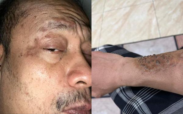 Gambar menujukkan keadaan muka dan tangan Ustaz Kazim ditumbuhi beberapa ketulan kecil warna hitam yang dikongsi di Facebook.