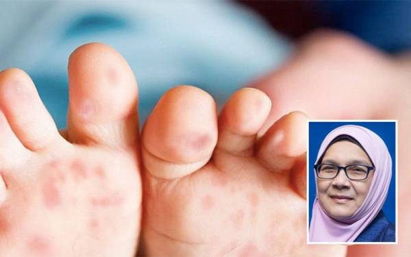 Sebanyak 18,164 kes HFMD dilaporkan di Selangor setakat 28 Mei lalu. Gambar kecil: Dr Siti Mariah