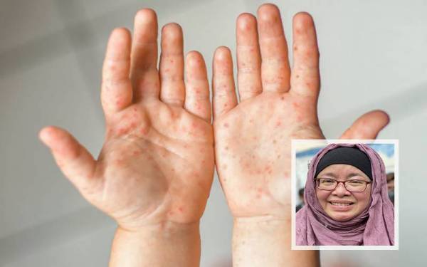 Pulau Pinang merekodkan sebanyak 4,263 kes penyakit tangan, kaki dan mulut (HFMD) sepanjang dari minggu epidemiologi pertama hingga minggu ke-23. (Gambar hiasan) . (Gambar dalam : Norlela)