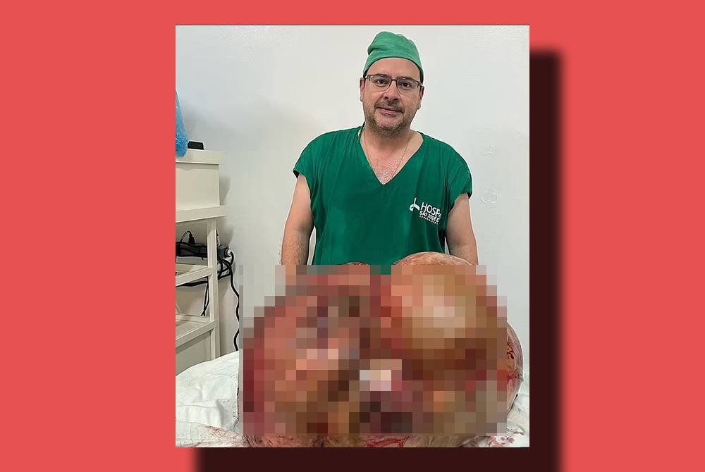 Sepasukan doktor berjaya mengeluarkan &#039;tumor gergasi&#039; seberat 45kg ketika pembedahan kecemasan di sebuah hospital di Brazil pada Rabu lalu.