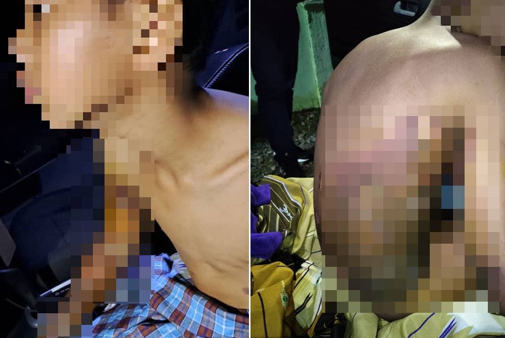 Kesan lecur pada bahagian badan mangsa.- Foto PDRM