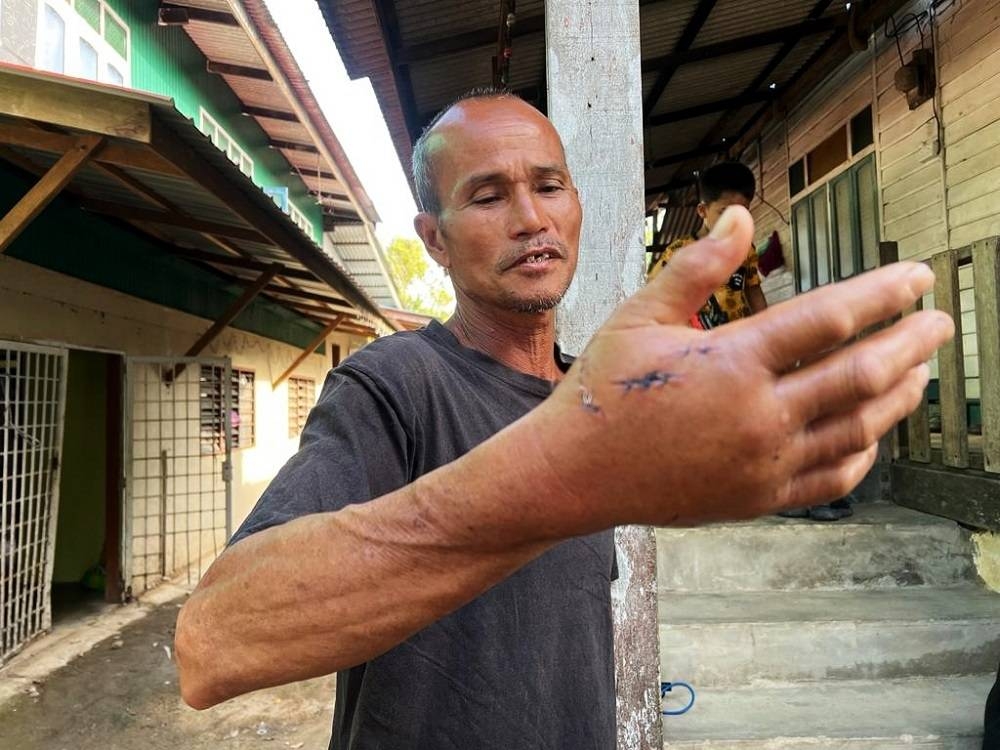 Che Man menunjukkan tangan kanannya yang cedera selepas digigit buaya dalam kejadian di Padang Papan, Manir pada petang Jumaat.