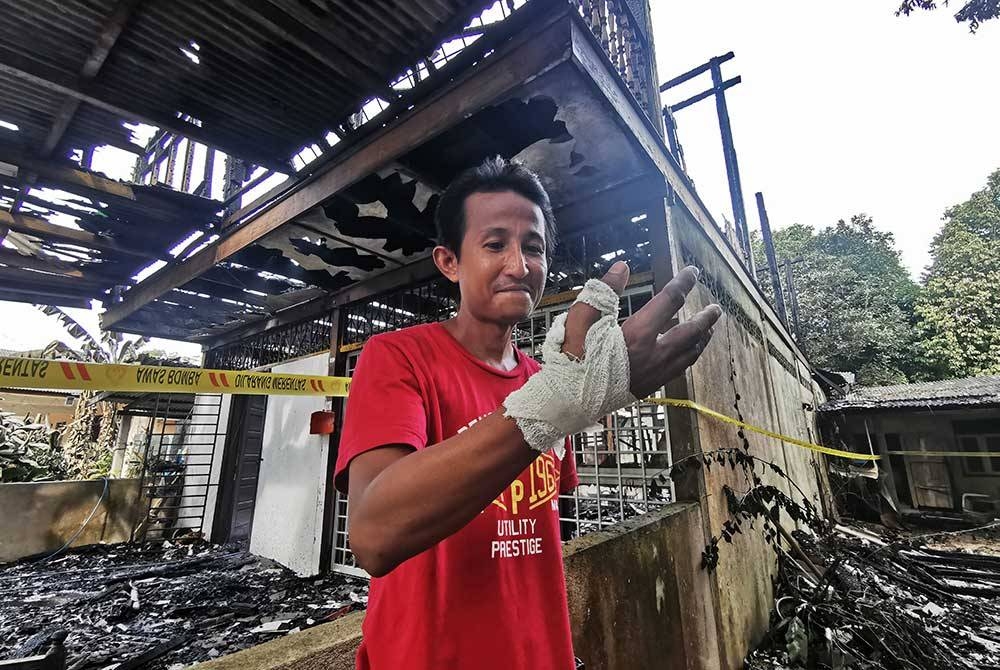 Jazli menunjukkan keadaan tangannya yang melecur akibat terkena api dalam kebakaran rumah di Kampung Pak Madah, Bukit Payong, Marang pada malam Selasa.