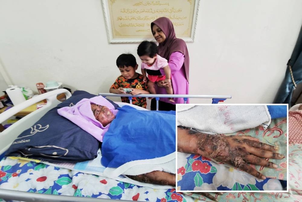 Aziantie di samping dua anaknya, Muhammad Fatih Andika dan Nur Aisyah Sofiyyah serta ibunya, Liza Suriani ketika ditemui Sinar Harian di Kuala Nerus, pada Khamis. Gambar kecil: Keadaan kulit tangan melepuh dan berkuping yang dialami di seluruh tubuh Aziantie