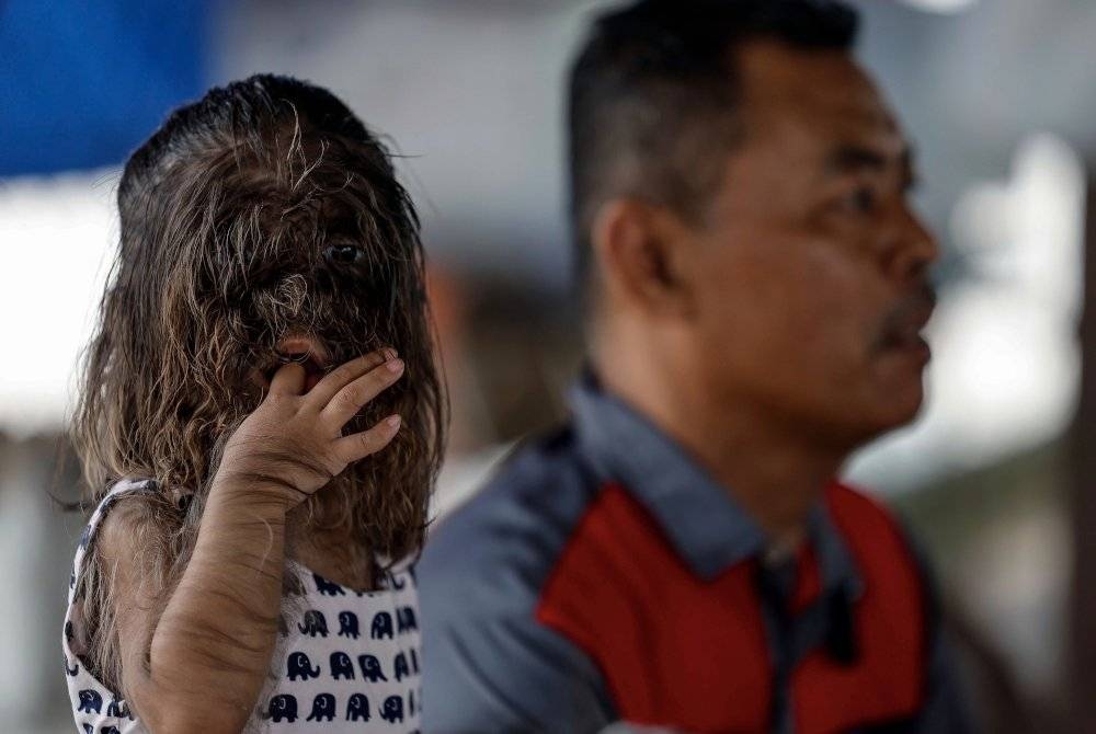 Missclyen Roland dilahirkan dengan wajah dan tubuh berbulu lebat akibat sindrom congenital generalised hypertrichosis (CGH). - Foto Bernama