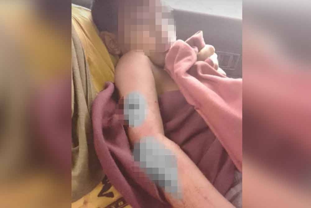 Tular gambar kanak-kanak cedera kononnya diserang harimau di Gerik rupa-rupanya dicakar beruk dalam kejadian di Kelantan, Isnin lalu. - Foto ihsan pembaca