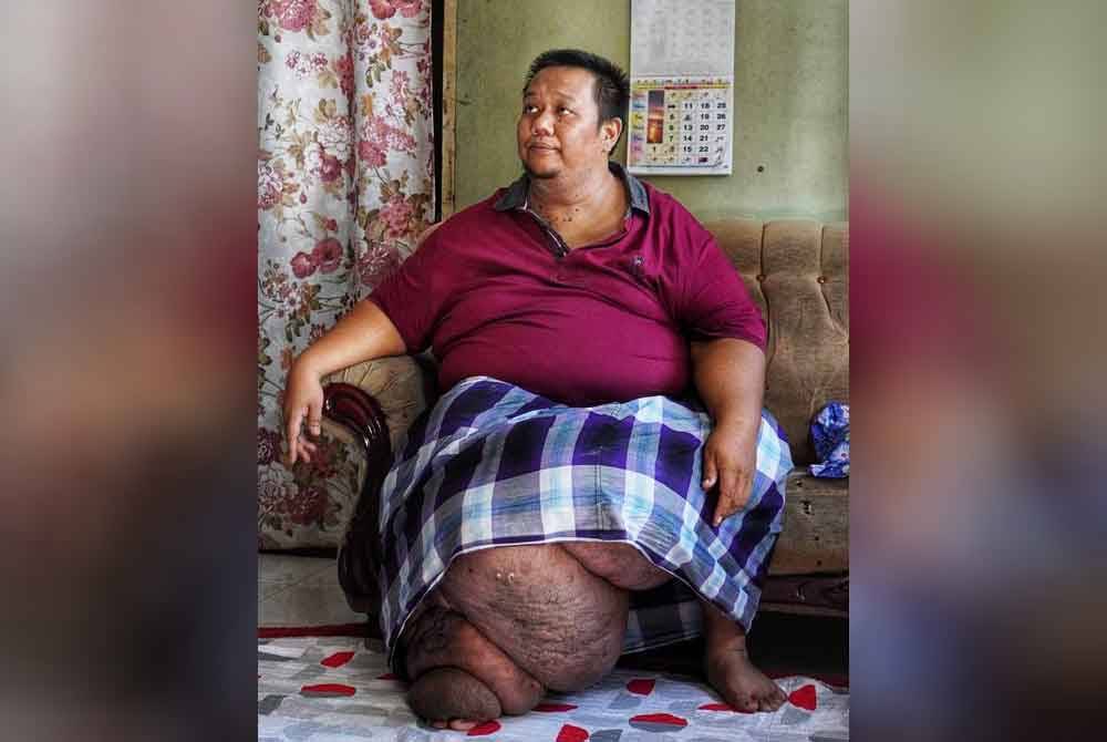 Keadaan kaki kanan Mohd Zulkifli yang membesar hingga berat lebih 60kg.
Pix FB Fadzli Kamal