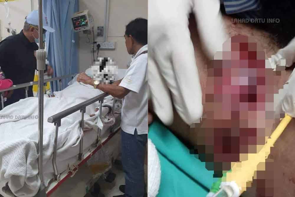 Mangsa parah akibat dibaham buaya tetapi dalam keadaan stabil dan dirawat di Hospital Tawau.