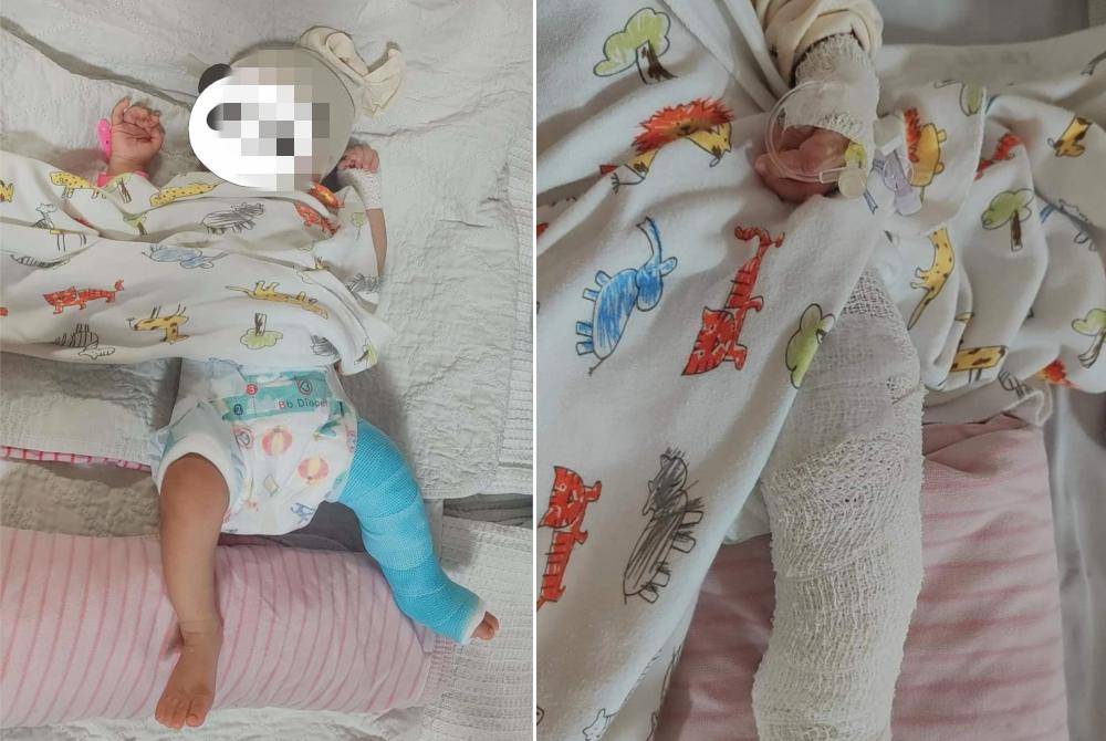 Bayi dua bulan patah kaki kiri disyaki didera pengasuh dalam kejadian di Bandar Dato’ Onn, Johor Bahru.