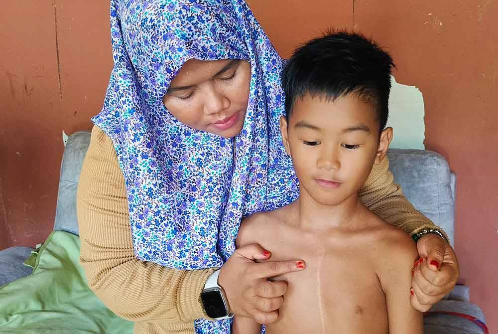 Nurliatul Hasni menunjukkan parut di dada Muhammad Ammar Solihin kesan pembedahan beberapa tahun lalu.