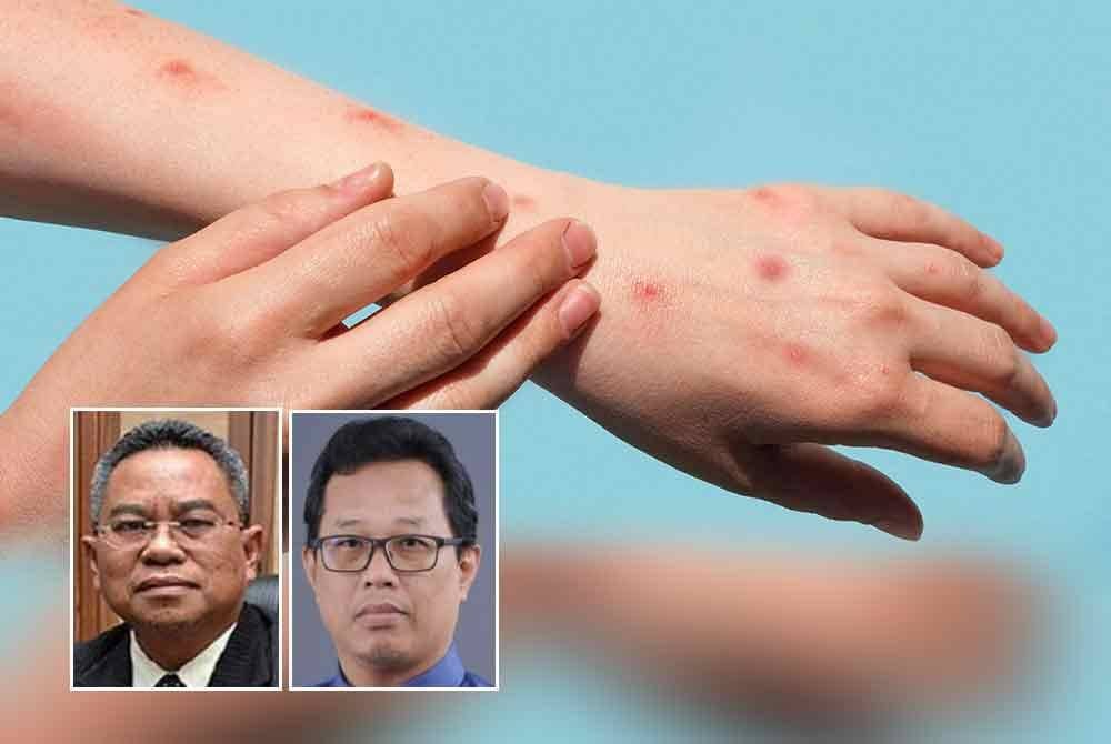 Biarpun Mpox tak bahaya seperti Covid-19, orang ramai dinasihati berwaspada terhadap risiko jangkitan. Foto NICD, gambar kecil dari kiri: Dr Zainal, Dr Wan Mohd Zahiruddin