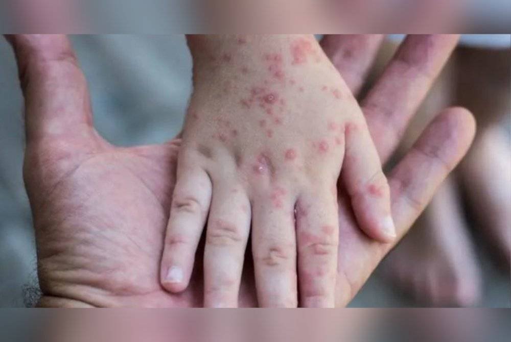 Kerajaan negeri mengambil langkah pengesanan awal bagi menangani penularan virus cacar monyet atau monkeypox (Mpox) di Selangor.