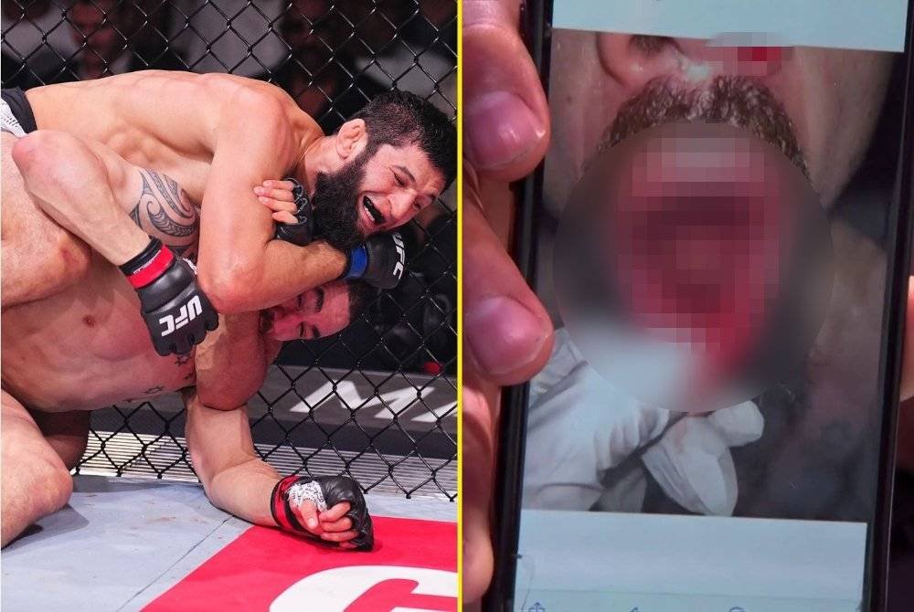 Beberapa batang gigi Robert Whittaker hancur dan tercabut selepas bertarung dengan Khamzat Chimaev di UFC 308. Foto Agensi