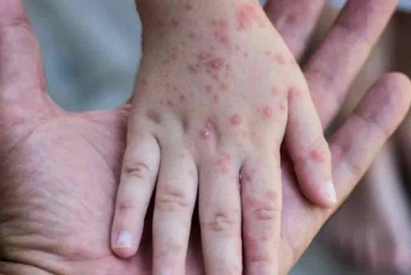 Satu lagi kes strain baharu mpox, Clade Ib mpox, telah dikesan di UK, menjadikan jumlah jangkitan meningkat kepada lima kes. Gambar hiasan 