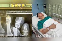 Imej imbasan X-ray jari kaki yang dikongsi Guan Eng di hantaran Facebooknya (kiri). Guan Eng (kanan) mendapat rawatan di Hospital Island Penang kerana kecederaan kecil pada jari kakinya.